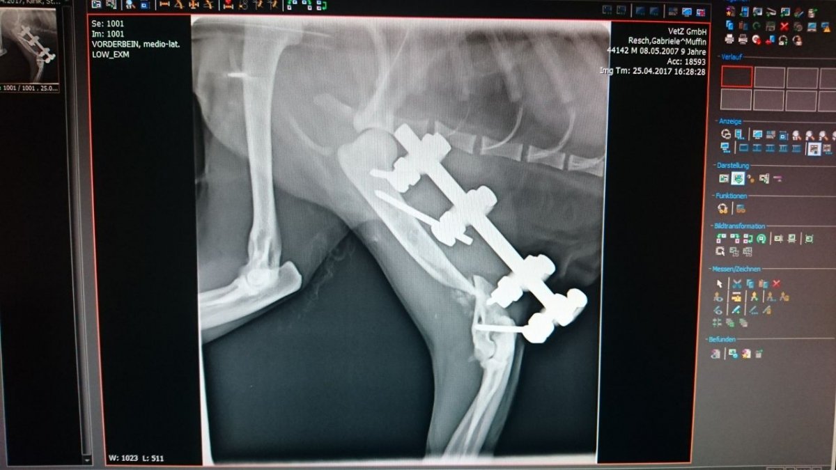 Der Trümmerbruch mit Fixateur und eingesetzter Knochenmasse aus seiner Hüfte
